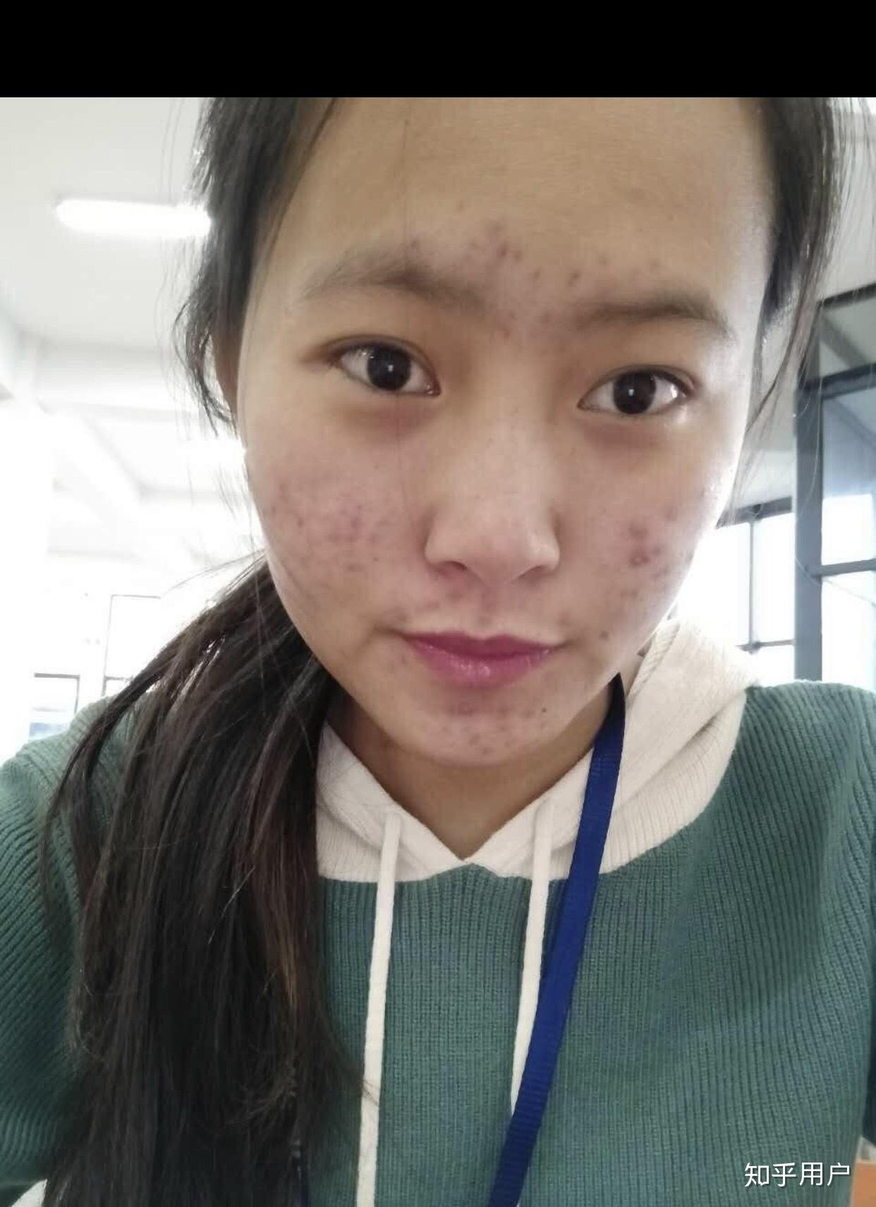 女生脸上毛孔粗大,有黑头,痘痘,怎么护肤?