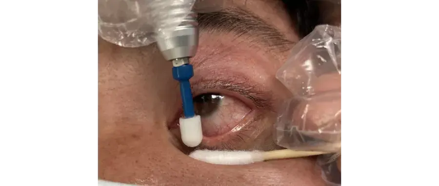 清洁睑缘首先需要做睑缘深度清洁,将睫毛根部的麟屑完全清除干净,打开