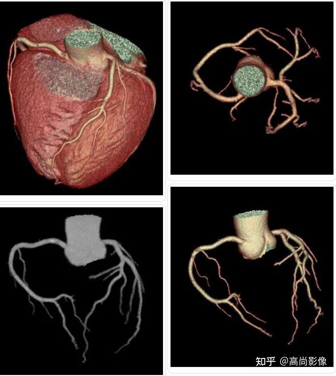 冠心病冠状动脉搭桥术后桥血管正常冠心病支架植入术后冠心病冠状动脉