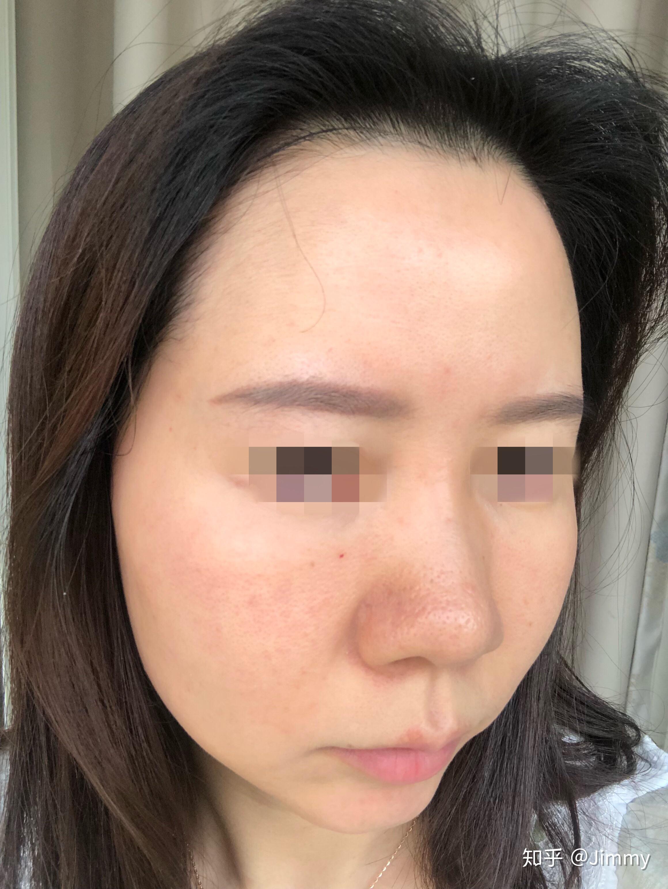 韩国露飞ruffy婴儿针