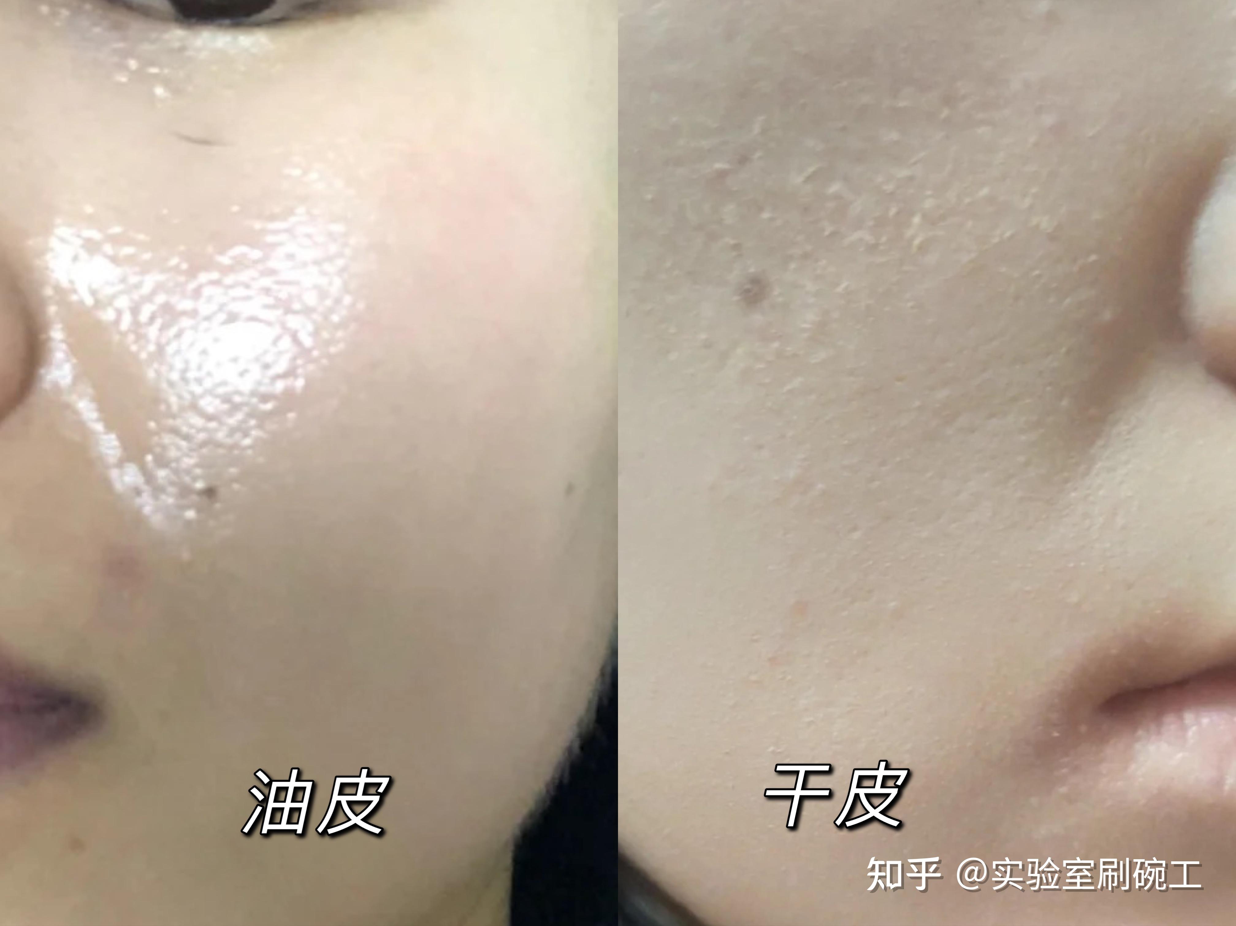 总听到干性皮肤,油性皮肤,如何样判断自己属于哪一种肤质?