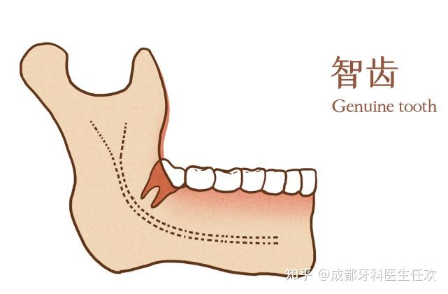 智齒是32顆牙齒中最後長出的牙齒,是人們的第三磨牙,一般在18-25歲