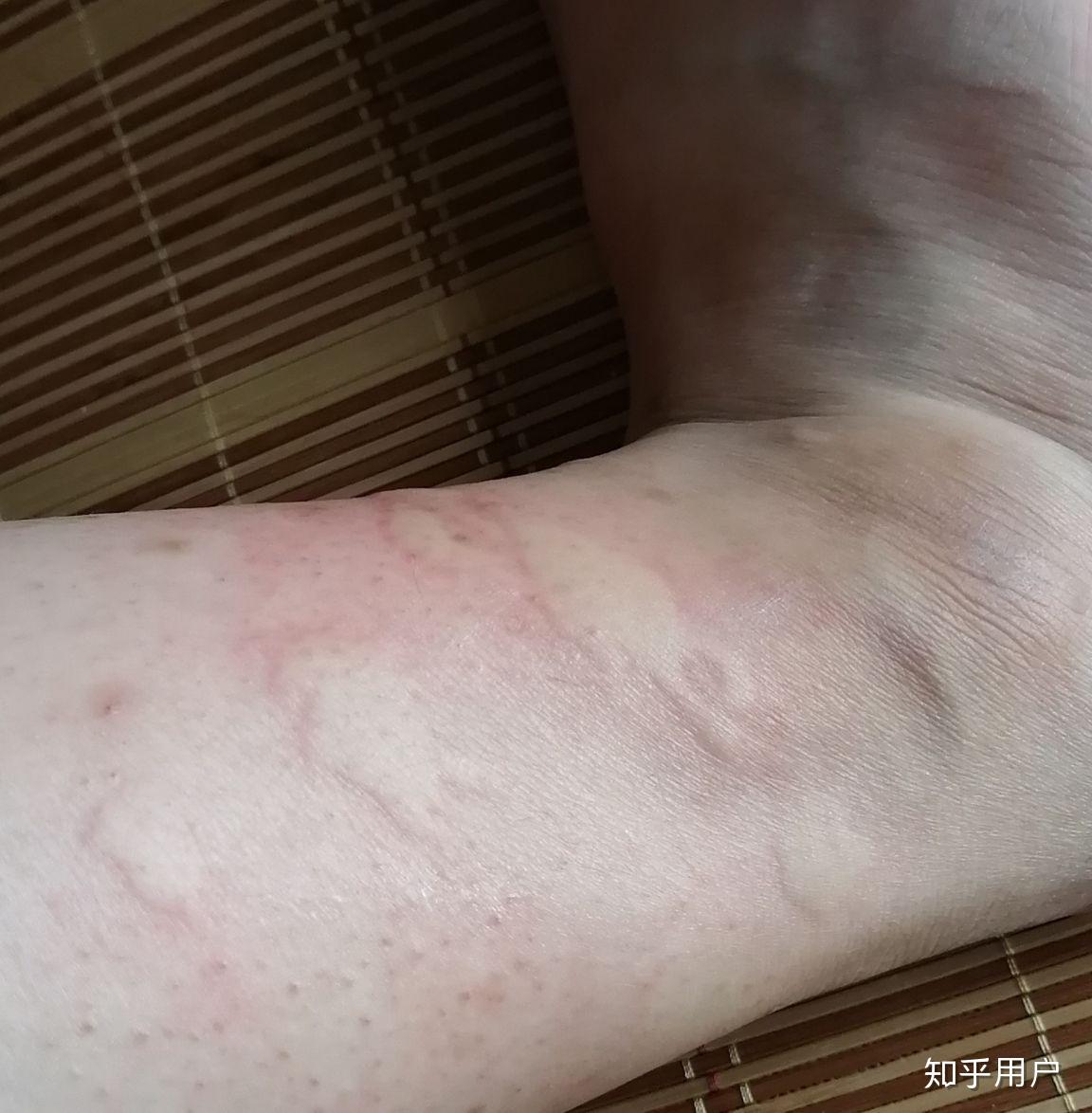 你们被蚊子咬过最大的包有多大?咬的位置在哪里?