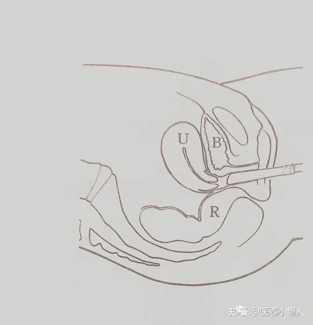 妇科膀胱截石位图图片