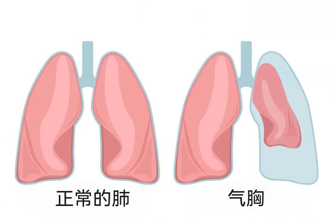 肺也会“爆”?没开玩笑,你的肺可能正在“崩溃” - 知乎