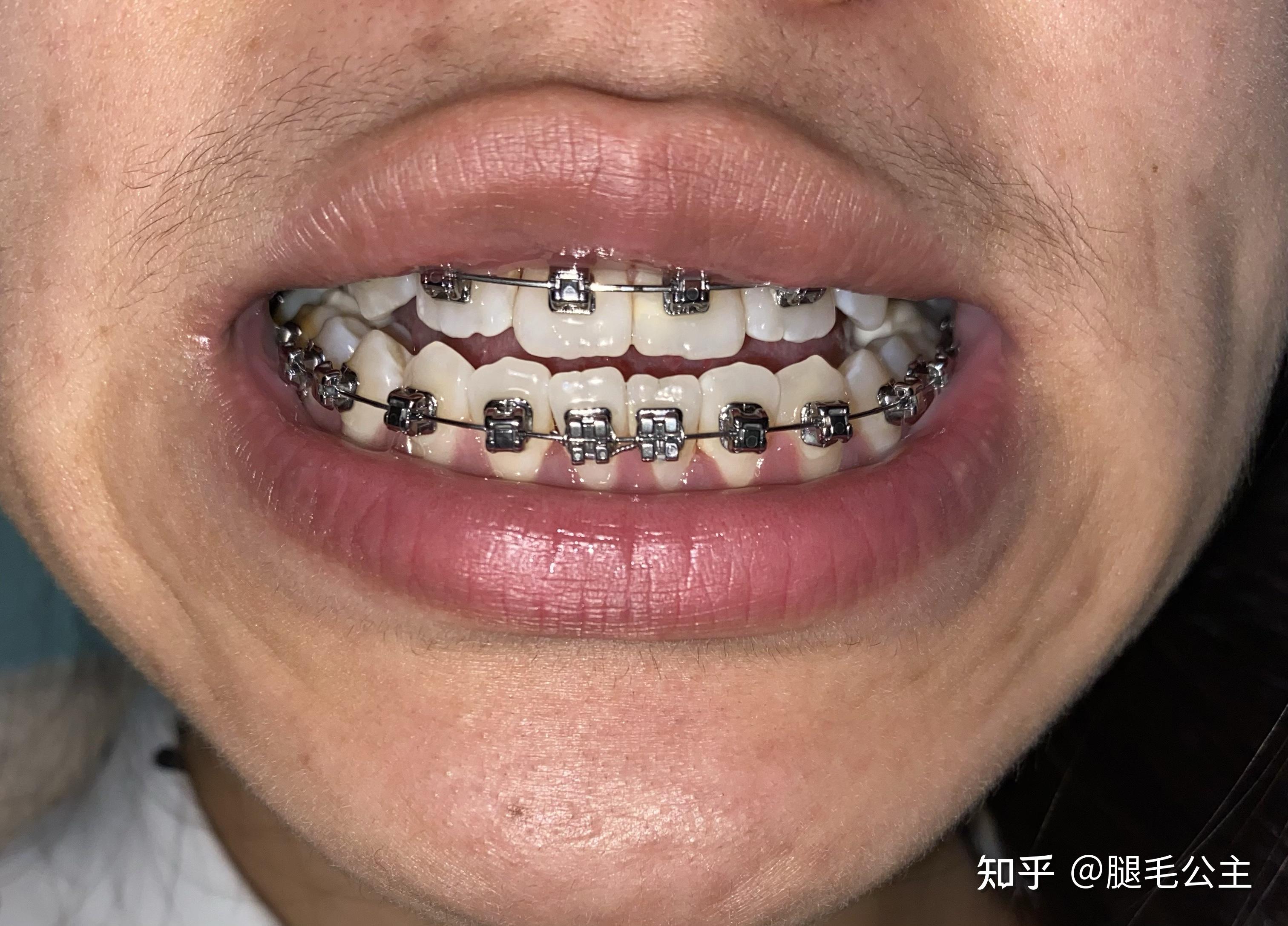 牙齿反颌骨性正畸日记