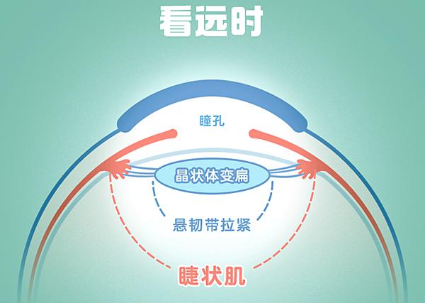 導致睫狀肌痙攣,看遠時無法放鬆調節形成的假象,是一種