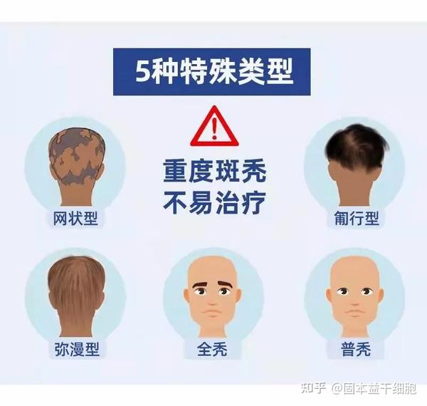 斑秃,鬼剃头,“秃”如其来,还有救吗? - 知乎