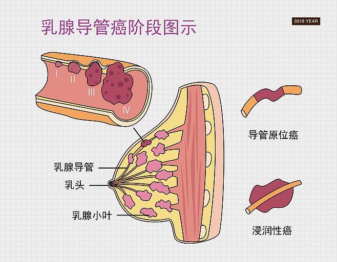 乳腺癌是女性第一杀手 预防它