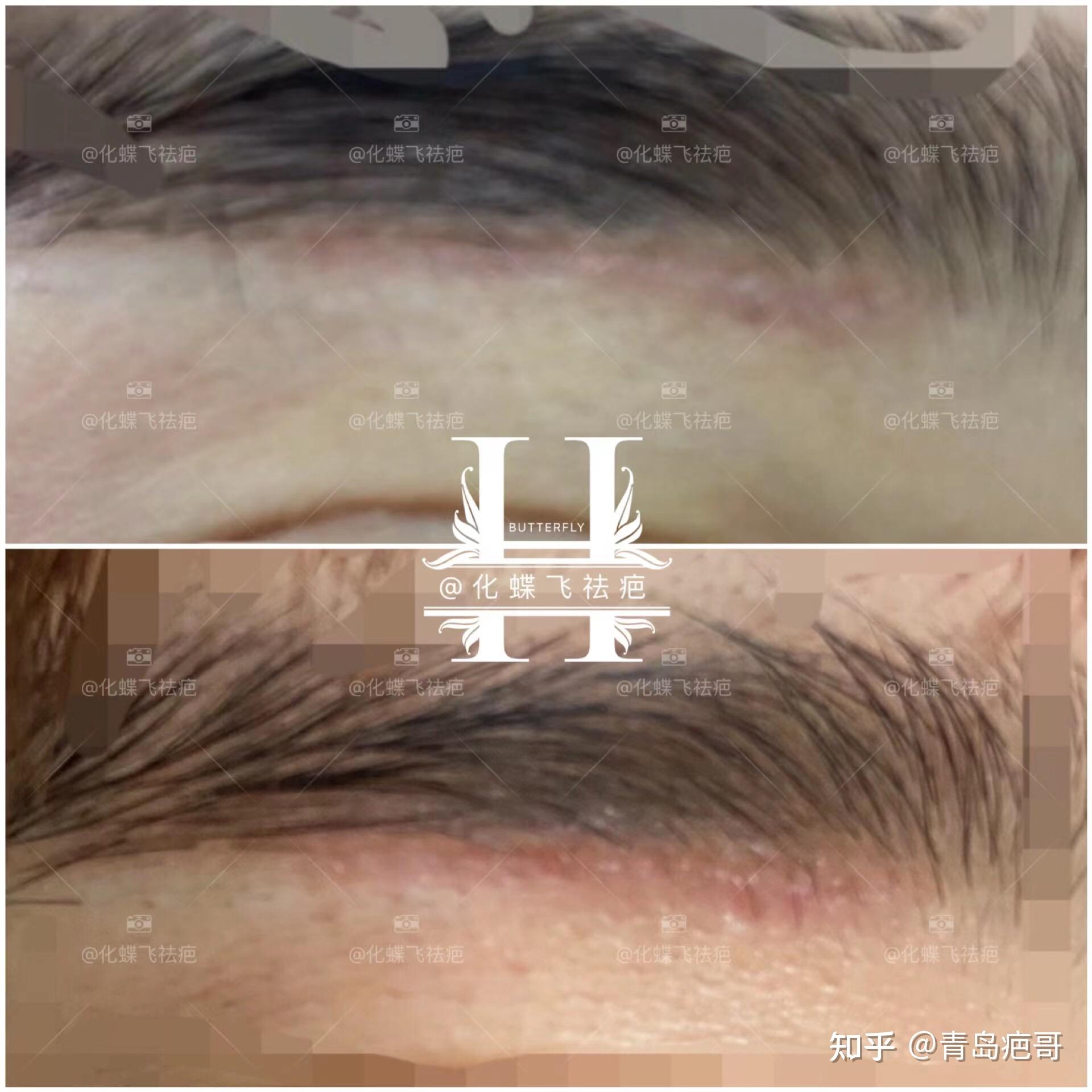 护士小姐姐激光洗眉疤痕修复