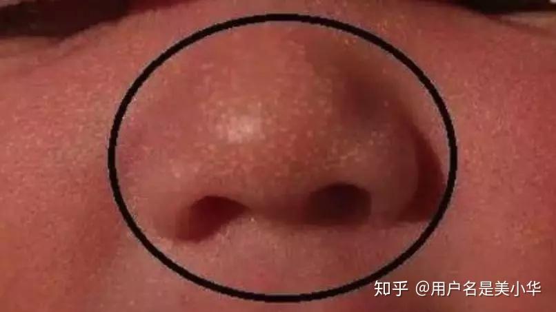 挑馬牙擠乳頭綁腿新生兒的這些表現都不是病