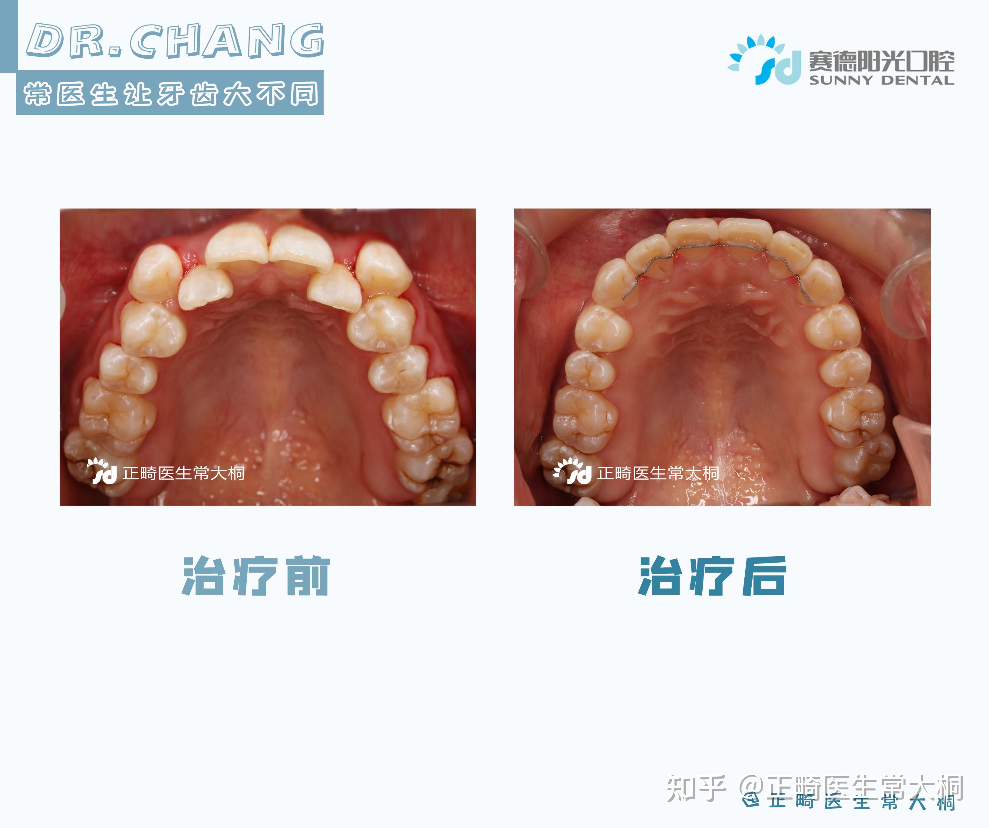 虎牙突出+牙齿拥挤不齐+个别牙反颌矫正案例 - 知乎