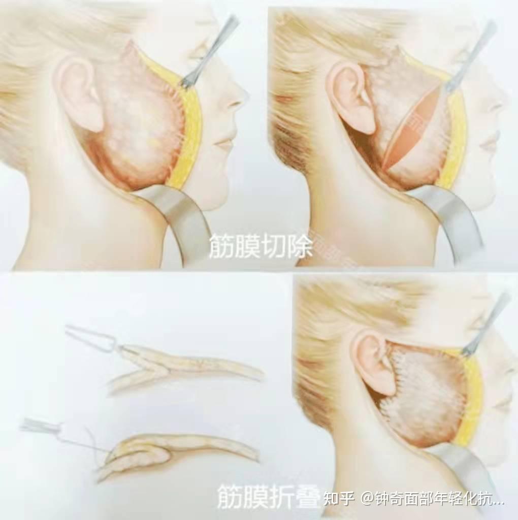 smas筋膜层的处理是拉皮抗衰的重中之重