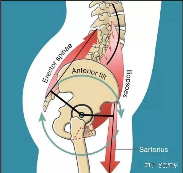 往往同時還伴有腹肌,臀大肌鬆弛無力,導致骨盆受力不平衡,被拉向前傾