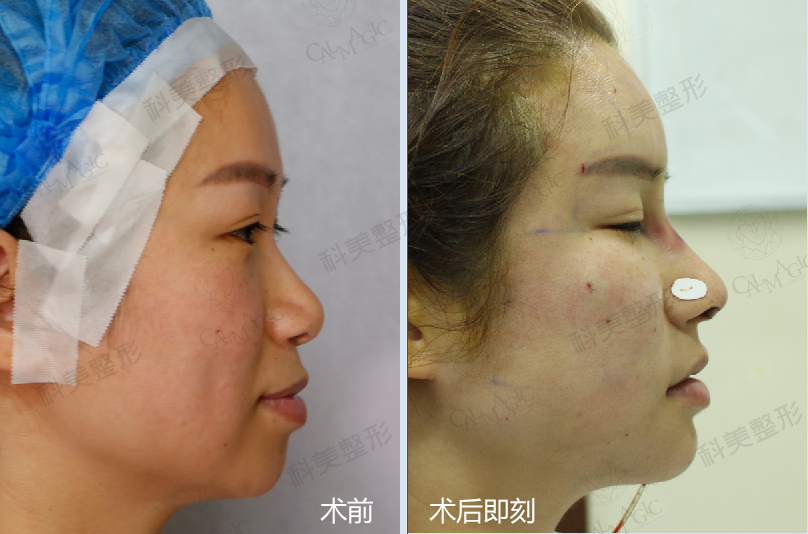 术后即刻效果分享
