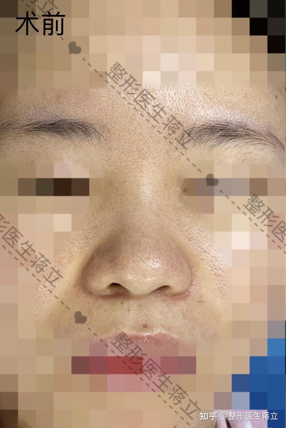 面中凹,嘴巴凸,下巴收缩,皮肤偏厚,毛孔明显,正面鼻头圆钝,鼻翼宽,侧面想整体加高,拉面中 - 知乎