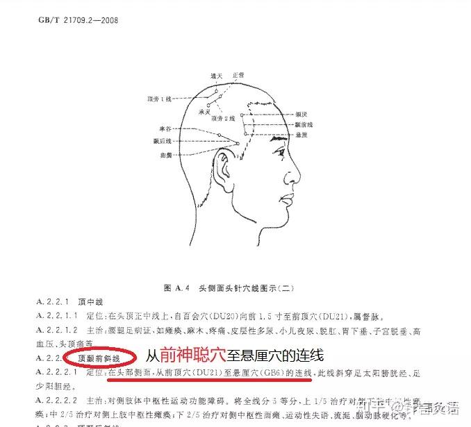 中风系列│头针疗法治疗中风