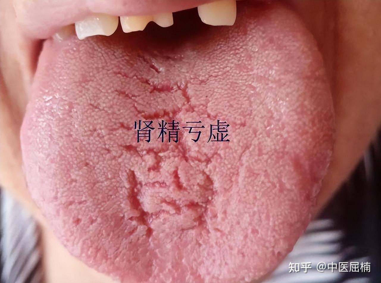安成中醫: 中醫看舌頭到底在看什麼？(二) 舌苔 (下) ─苔質