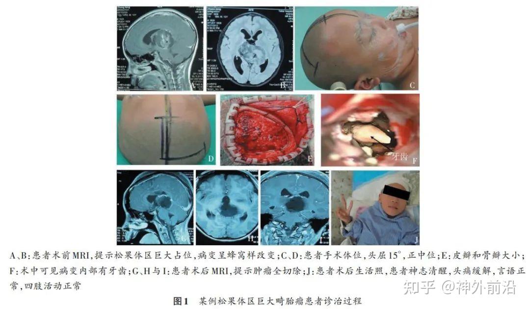 松果体区畸胎瘤图片