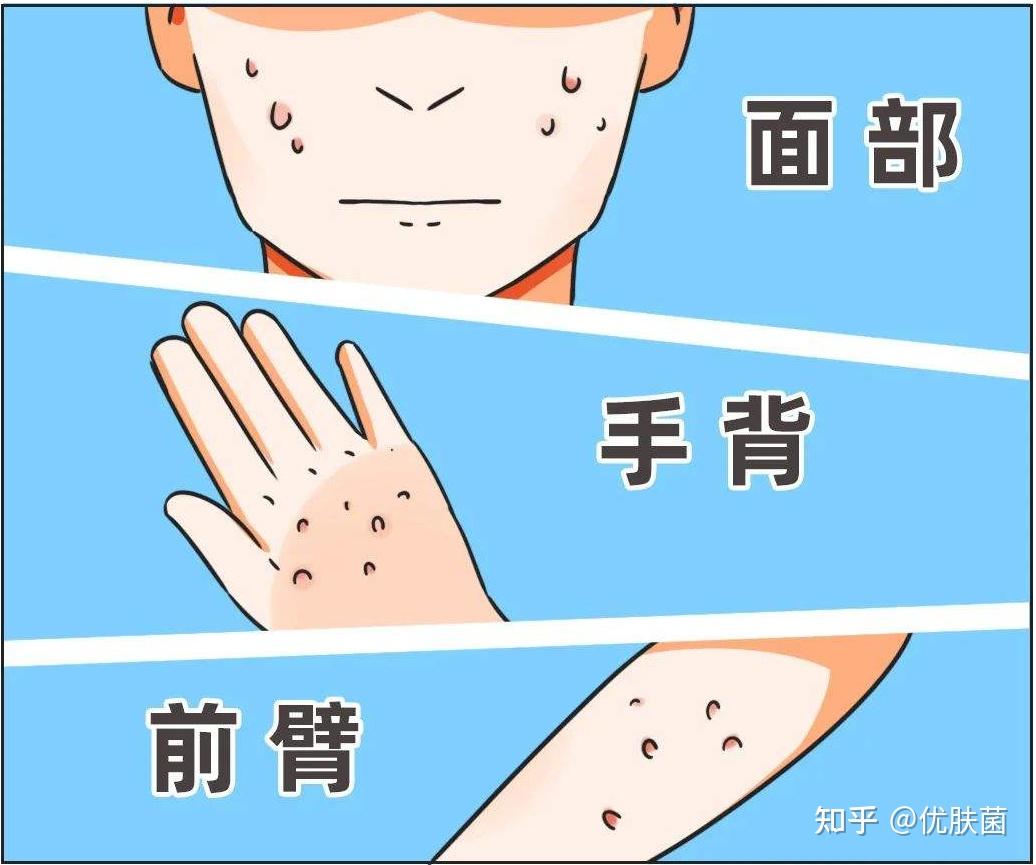 皮肤上长了很多小疙瘩,是痘痘还是扁皮疣? - 知乎