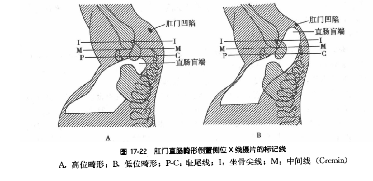 先天无肛门手术图解图片