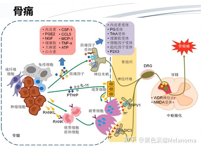 骨转必看第一篇黑色素瘤骨转移的机制与影响