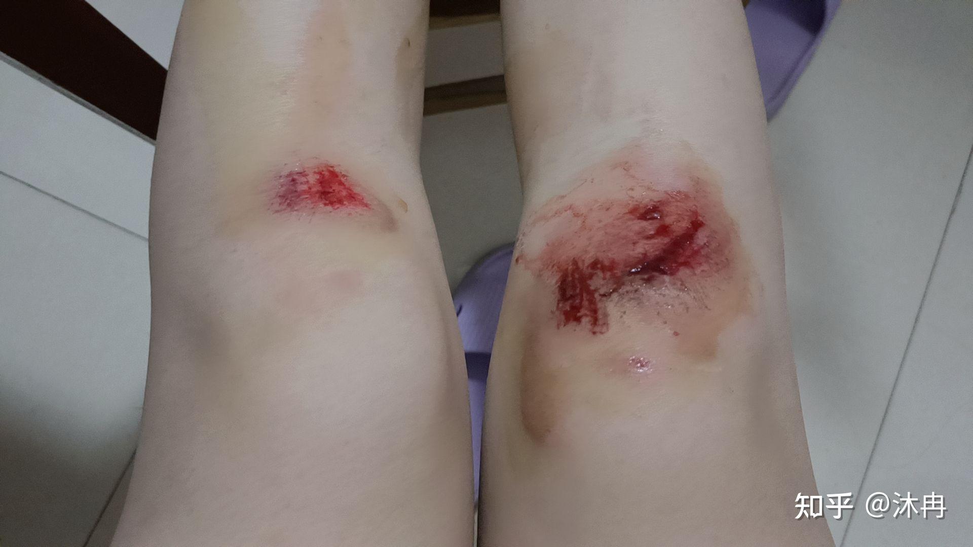 骑电动车摔跤伤口图片图片