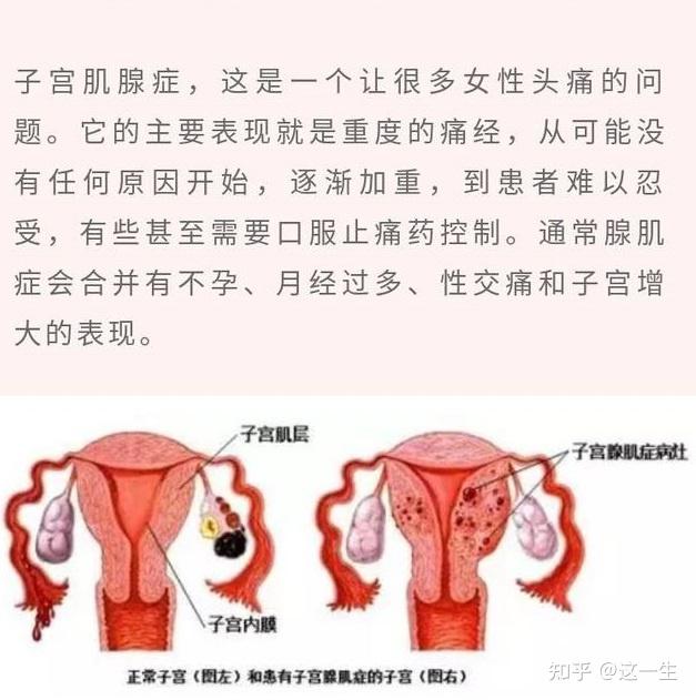 痛不欲生的子宫腺肌症,中药通瘀可调理