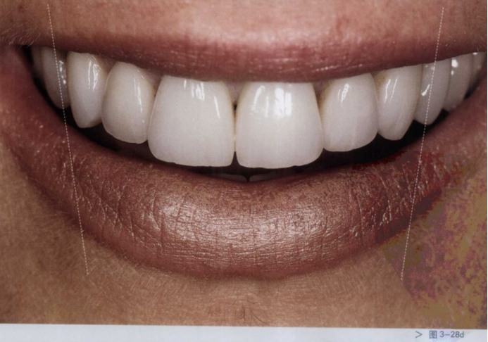 广州种植牙/口腔美学修复中的唇齿关系分析——这样才是好看又好用的