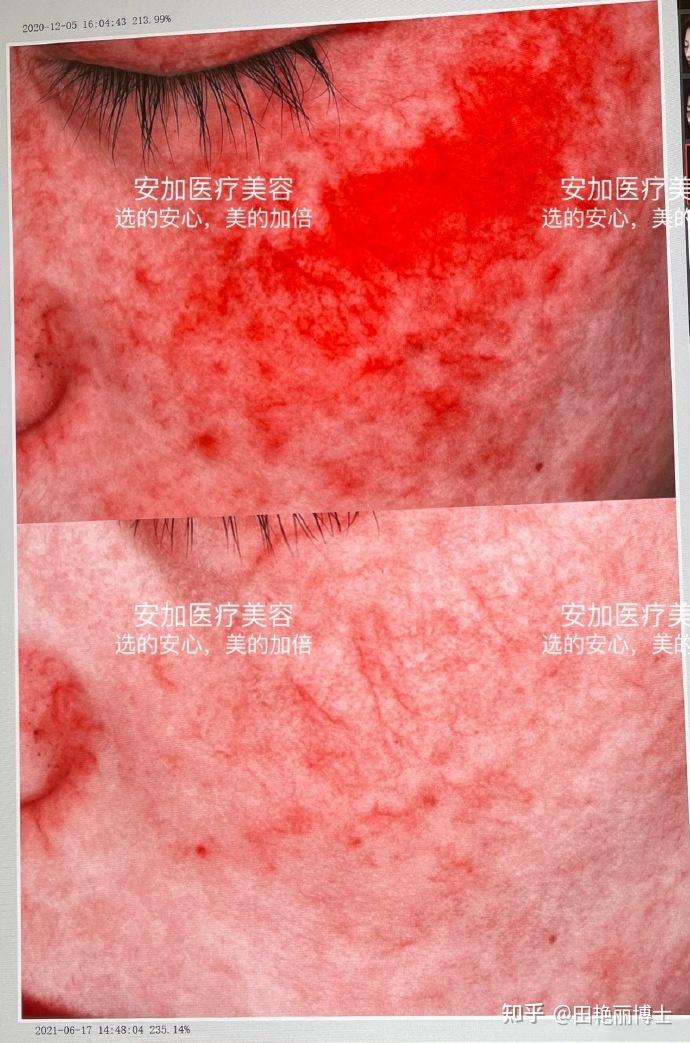 秋冬不会出错的百搭项目:K8舒敏之星 - 知乎