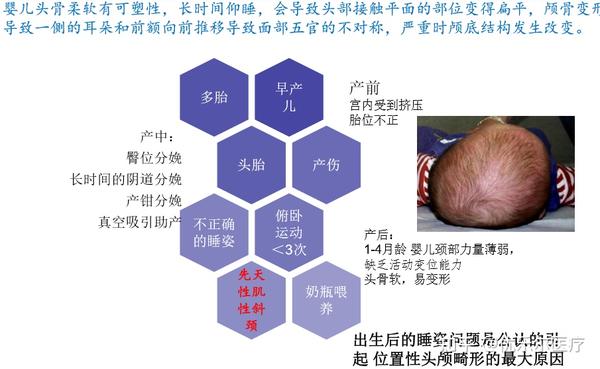 头颅畸形—舟状头 - 知乎