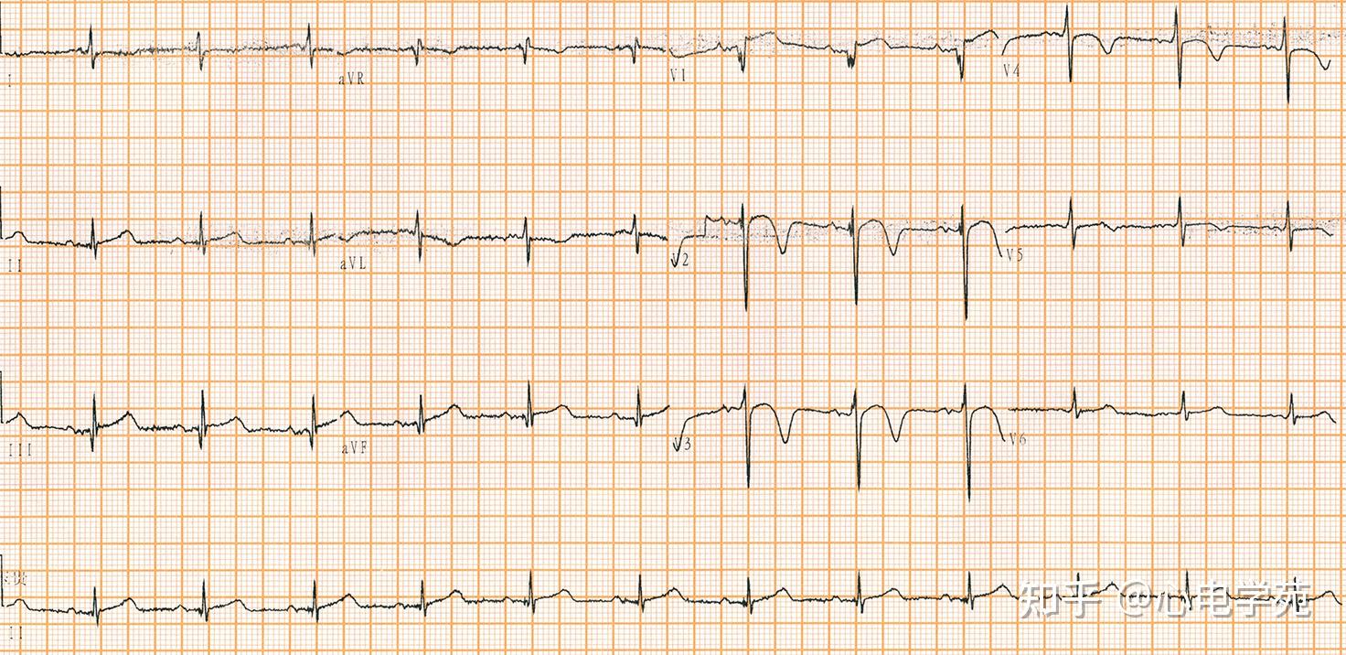 图3心电图分析:图3记录于急性前间壁心肌梗死第7天,前降支,右冠脉pci