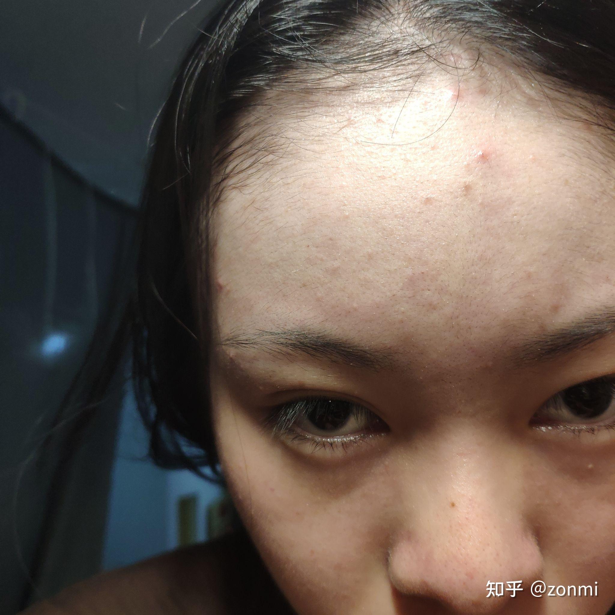 记录下脂溢性皮炎治疗过程