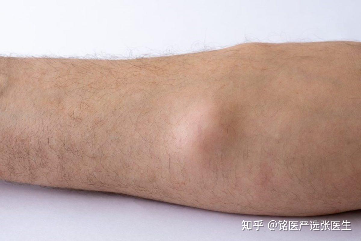 手臂上有很多小疙瘩不痛不痒 是不是脂肪瘤? - 知乎