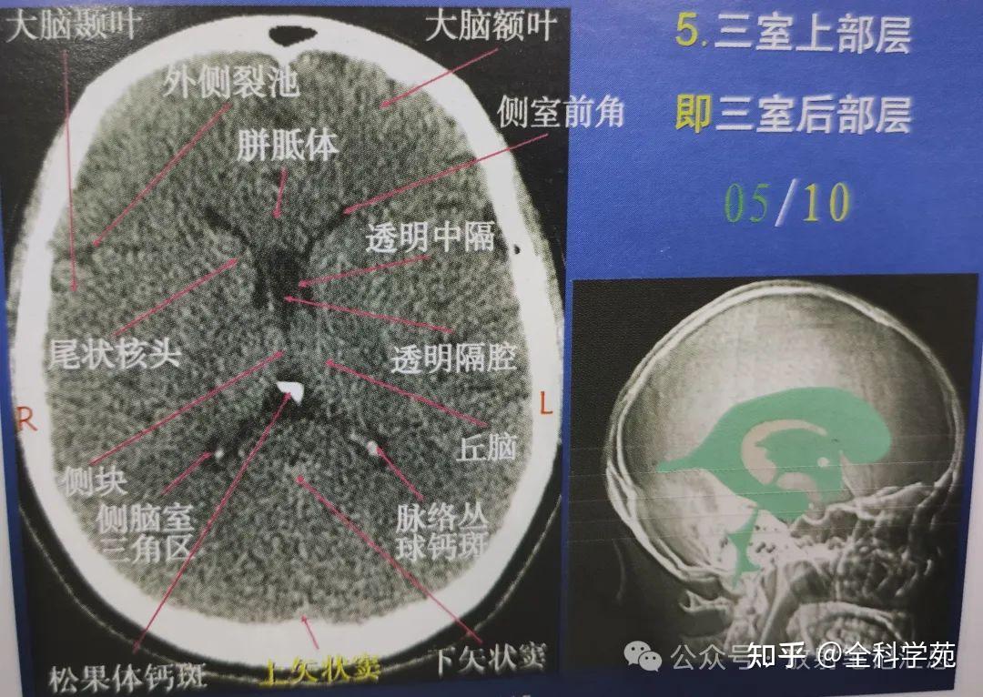颅脑解剖、脑叶及CT表现 - 知乎