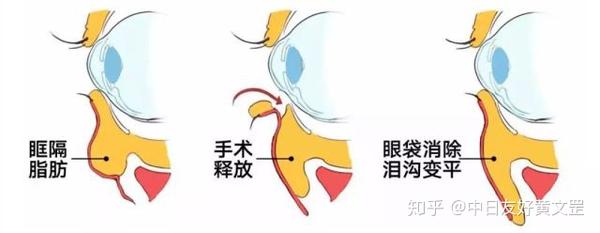 有了泪沟太显老?3种方法教你摆平泪沟 - 知乎