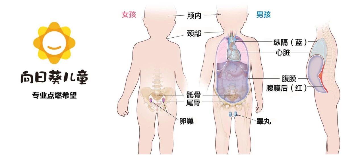 5年生存率可能低到40 成熟和未成熟畸胎瘤到底怎么治 知乎 5年生存率可能低到40 成熟和未成熟畸胎瘤到底怎么治 知乎