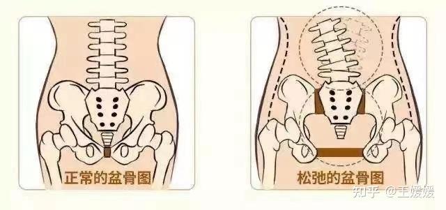 產後骨盆變形恥骨聯合分離問題出在哪裡