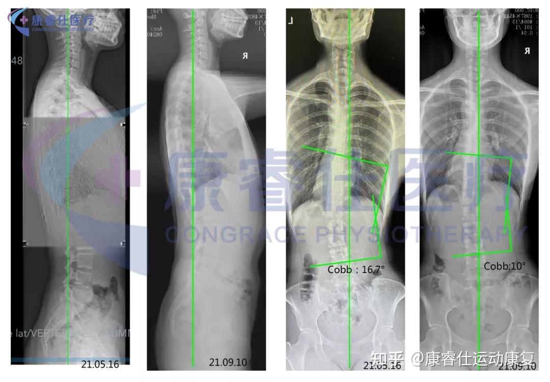 案例分享|成年人脊柱側彎可以矯正和治療? - 知乎