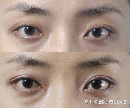 就会多处粘住,形成多层双眼皮;双眼皮是使人睁开眼睛的肌肉和眼皮的