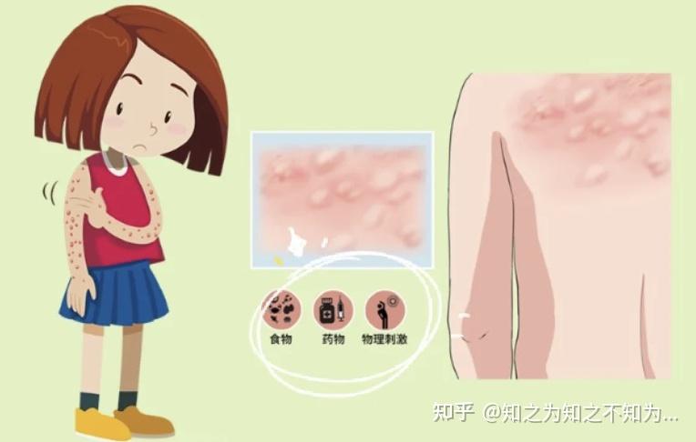 过敏性紫癜患者能吃什么不能吃什么