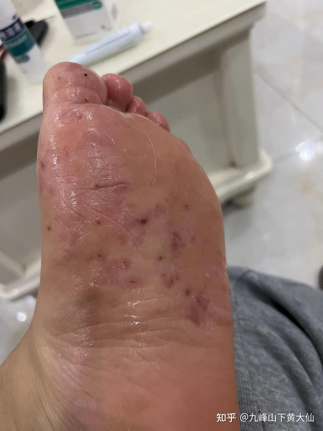 更新脚气治疗全过程~(配图)