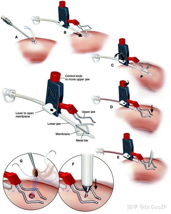 安装"易扣"后主动脉上就可以比较从容的打孔了.