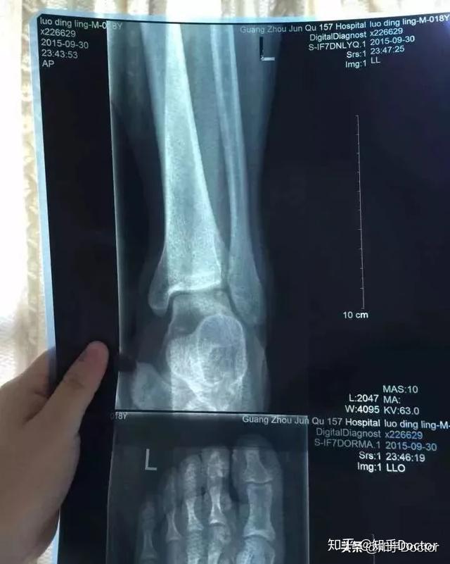 骨折拍了x线为什么还要做ct和mri