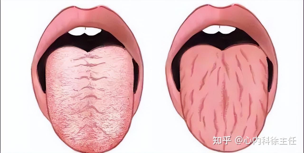 从舌头来看心脏问题,6大舌象,警惕心梗 知乎