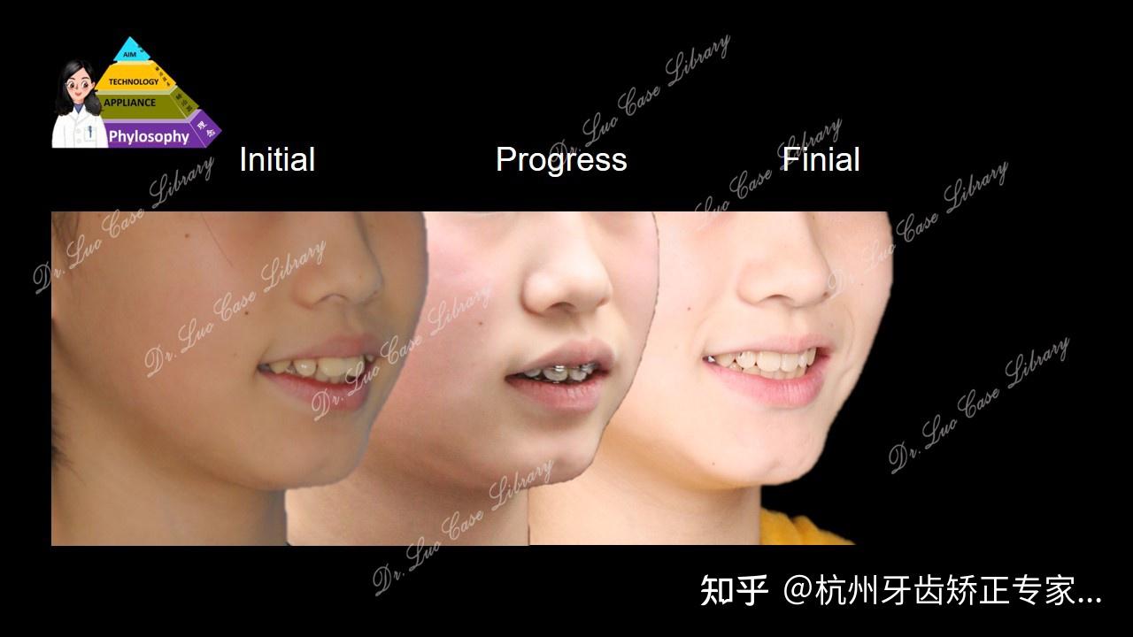 突面型患者的拔牙口外弓矫正