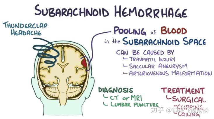 医学科普之蛛网膜下腔出血