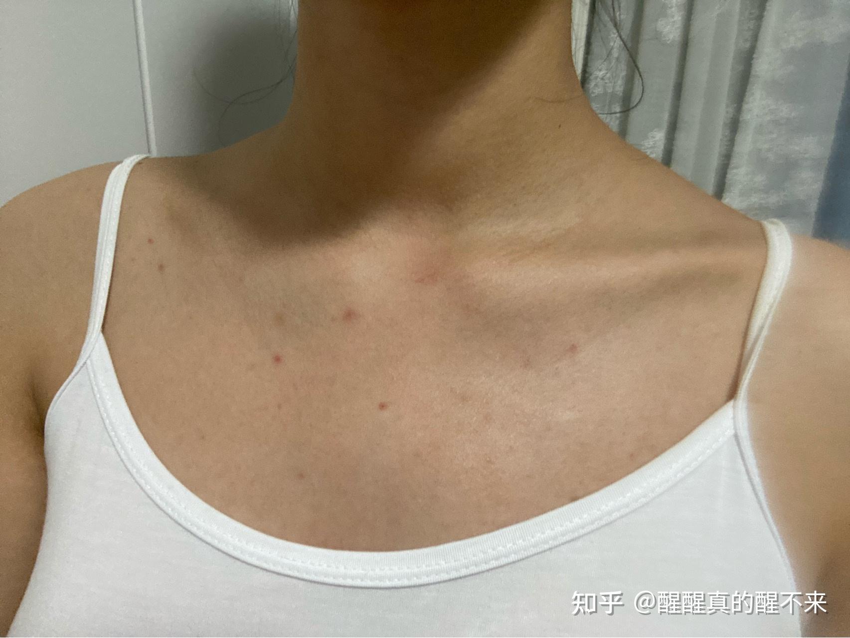 学生党皮肤黄怎么美白?有哪些适合学生党变白的方法
