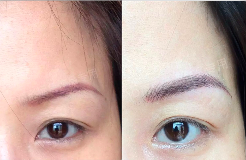 肖苗红蓝眉毛不要怕用这几招可避免激光之苦