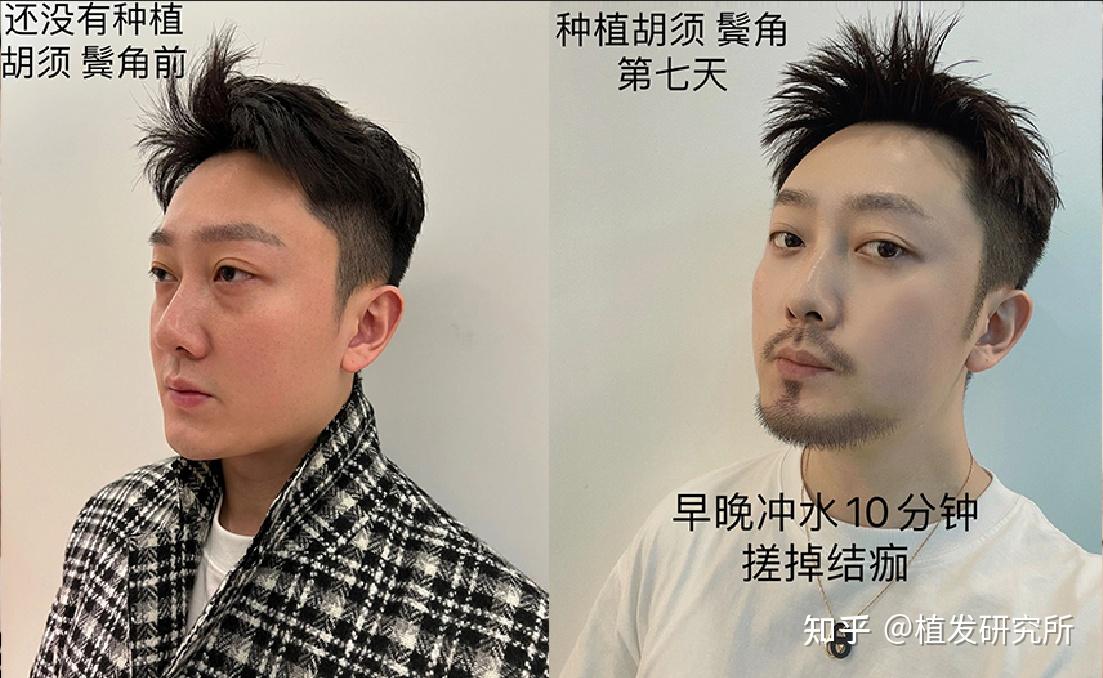 【植发趋势】亚洲男性适合做鬓角种植么?鬓角植发时需要注意哪些方面?美学植发篇来啦~ - 知乎